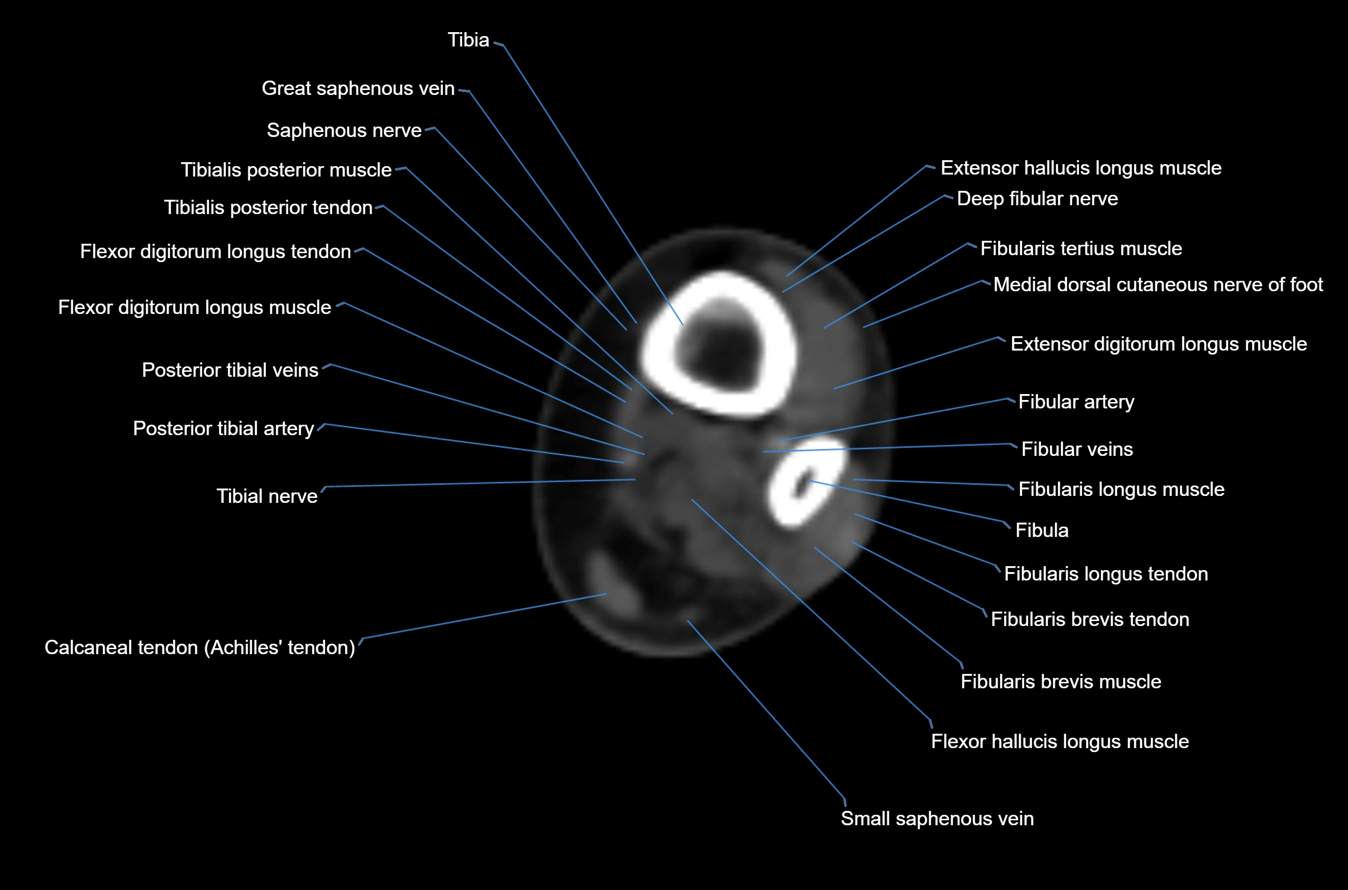 CT Ankle axial cross sectional anatomy labelled image -00010.webp